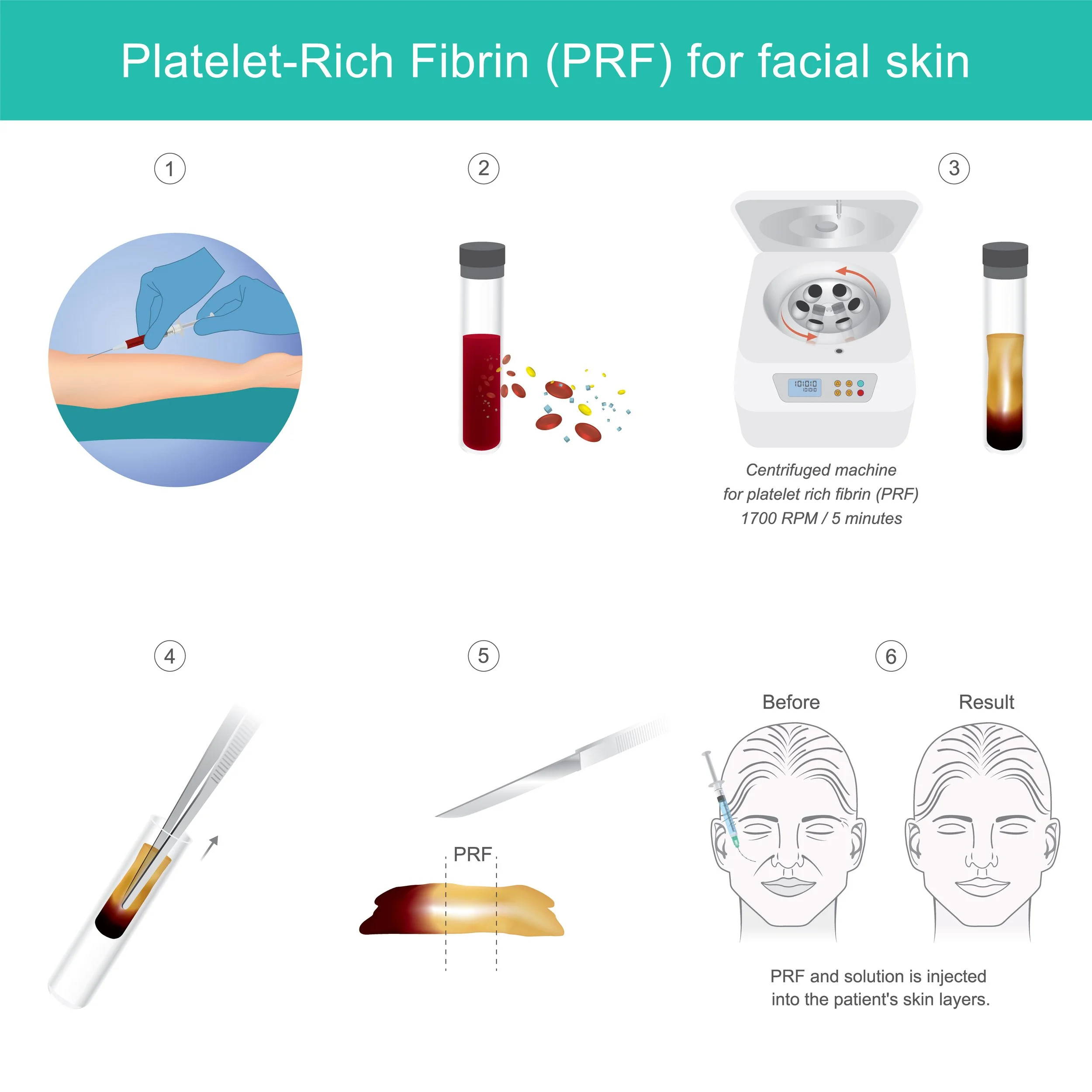 Infographic showing the steps involved in platelet rich fibrin injection treatment 