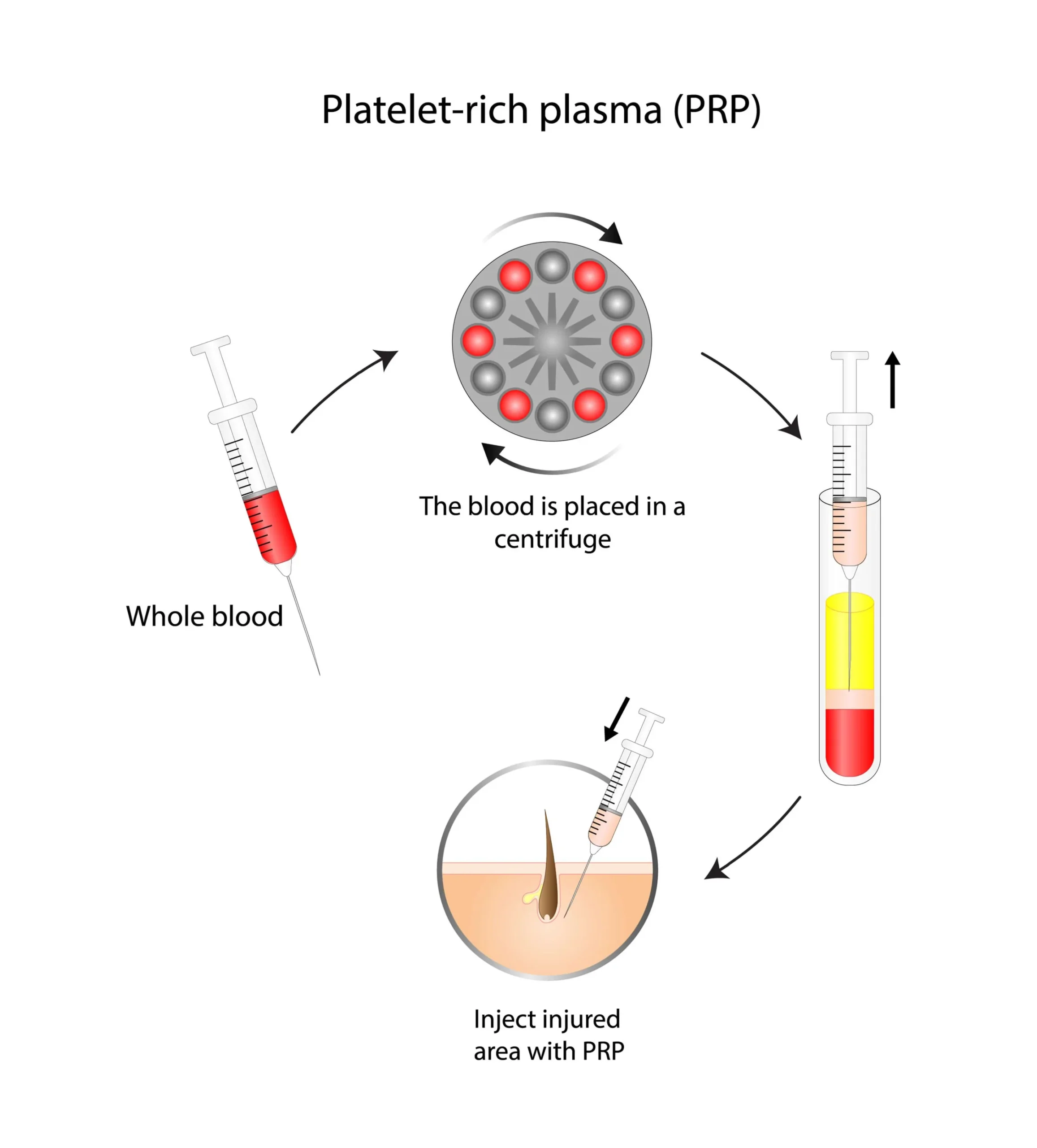 Illustration showing how PRP injections target hair follicles to support hair growth 