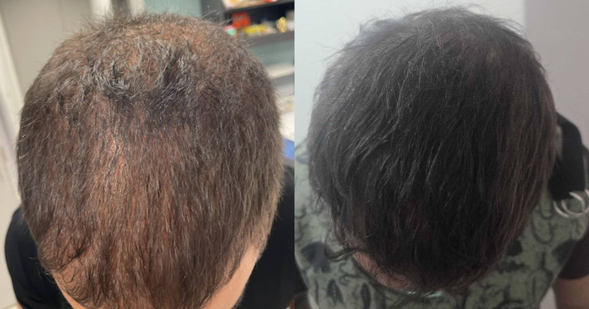 Before and after photos showing improved hair density after PRP hair loss treatment 