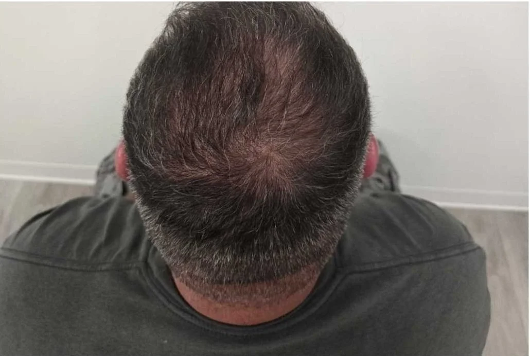 Series of before and after scalp photos demonstrating visible results from PRP hair restoration 