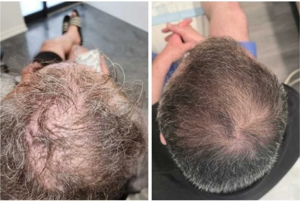 Series of before and after scalp photos demonstrating visible results from PRP hair restoration 