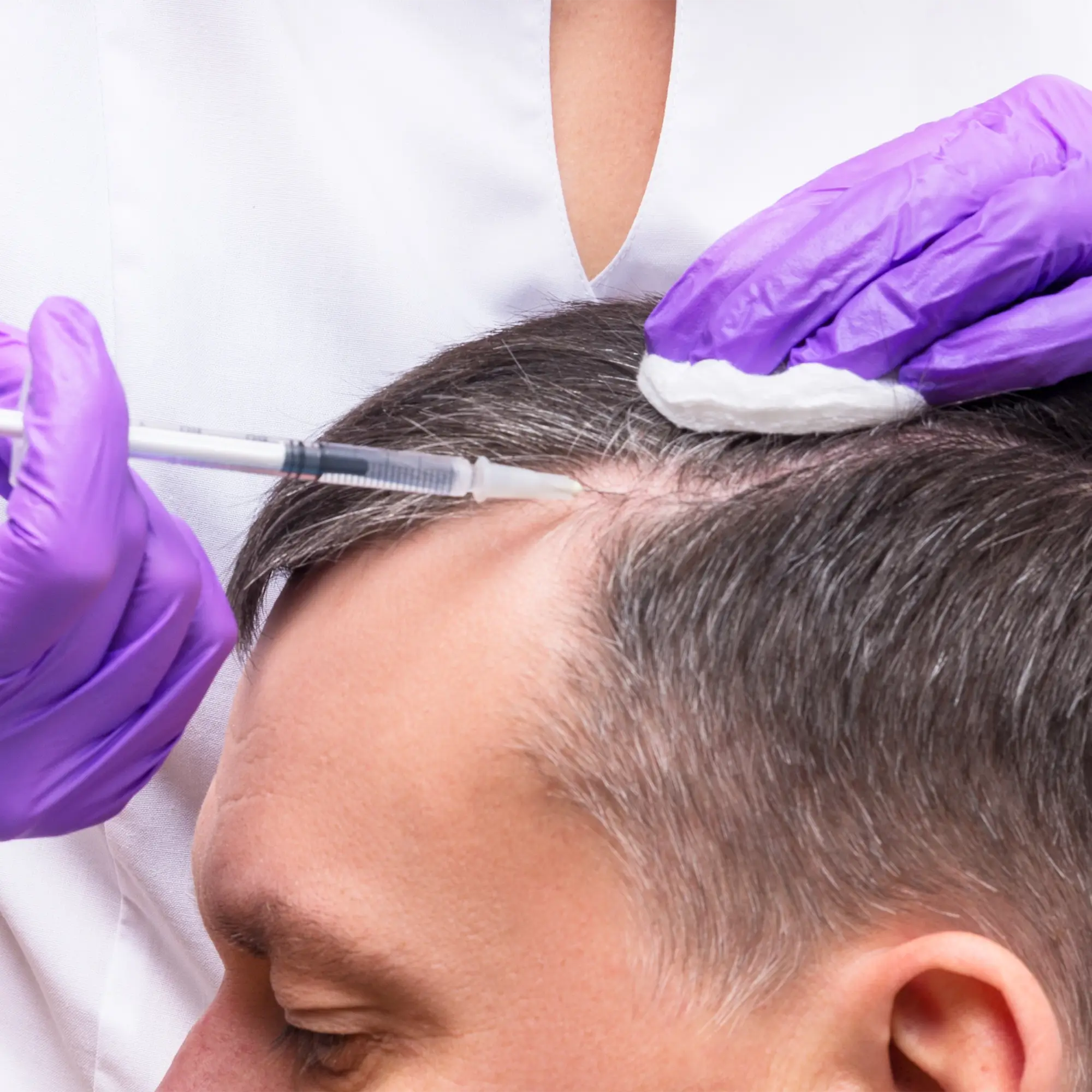 Clinician wearing purple gloves injecting PRP along patient’s hairline during hair loss treatment